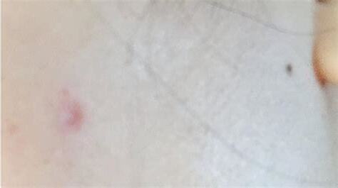 小腹有痣