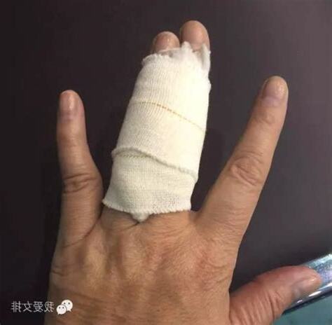 無名指受傷