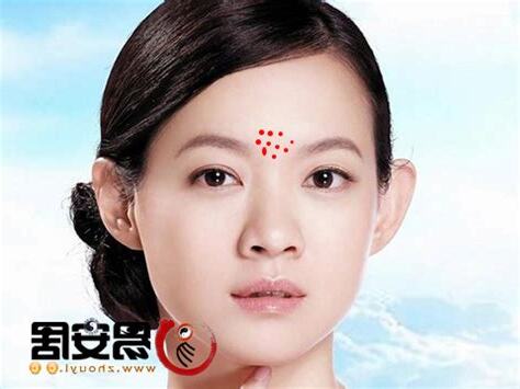 印堂長痘痘面相