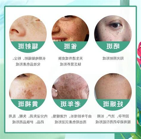 脸上黑斑如何去除