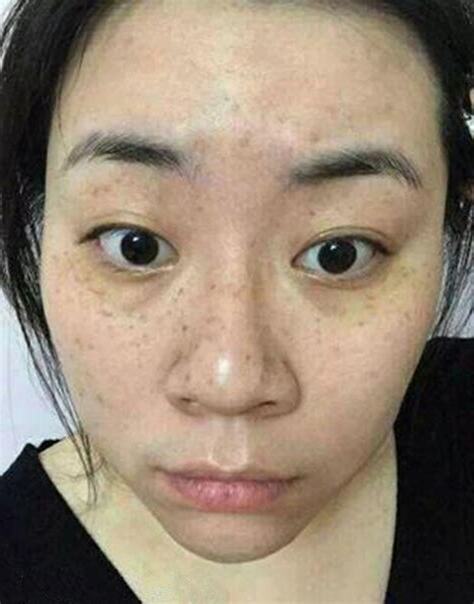 眼周黑斑
