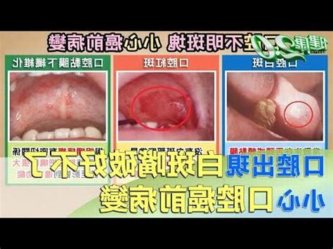 咬到嘴邊肉腫起來怎麼辦