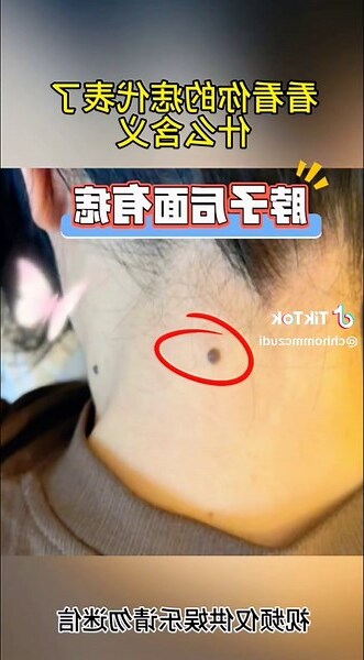 男人頸後有痣