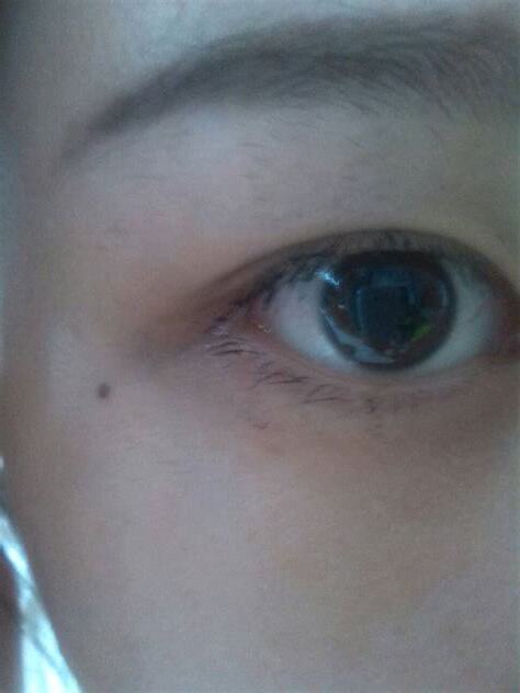 左眼皮上有痣