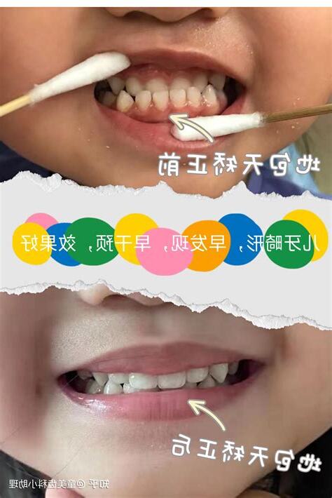 牙齿地包天