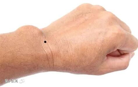 手臂上的痣代表什么
