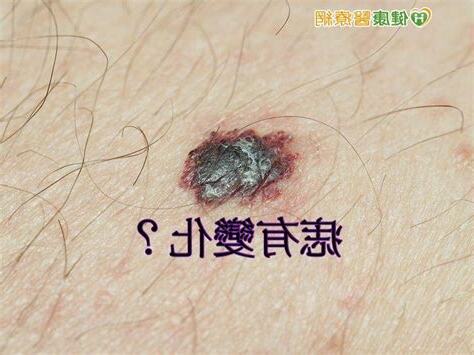 痣有變化