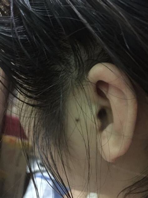 女生右耳有痣