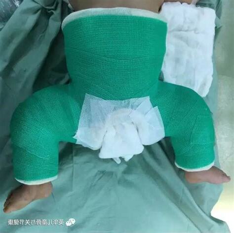 人字形石膏