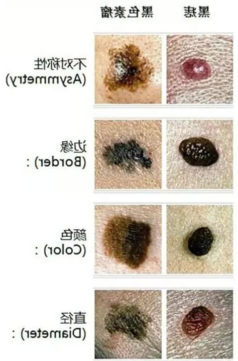 腋下痣癌