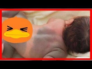 屁股青色胎記