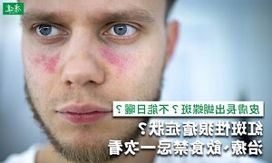 狼班性紅瘡