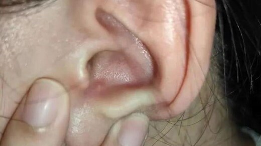 耳朵外面長痘痘