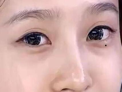 眼袋有痣女