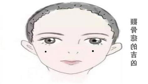 顴骨痣男