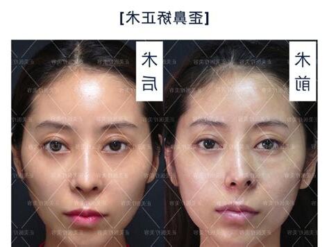 鼻子歪掉