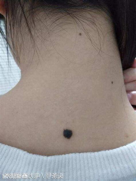 頸後有痣