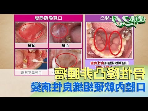 口腔內長起不知名的凸起物
