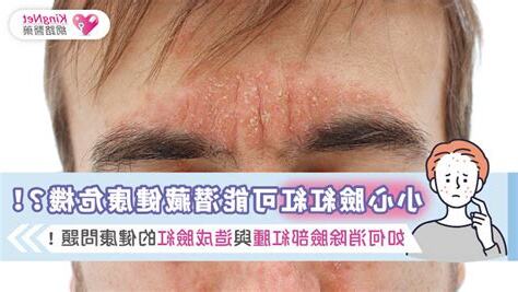臉會癢