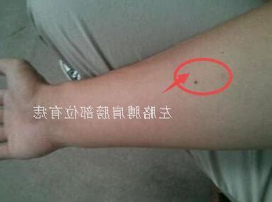 手臂長痣代表什麼