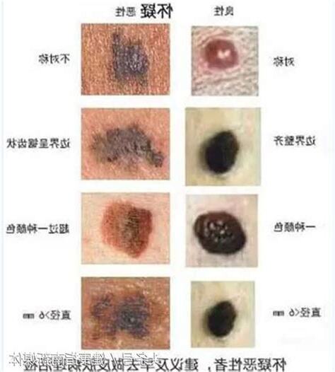身體莫名長痣