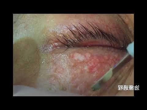 眼有水泡