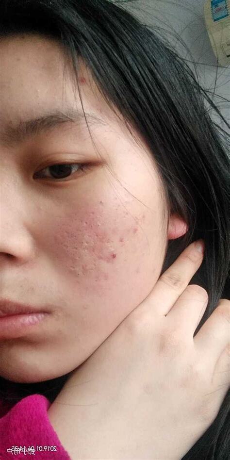 女生痘痘