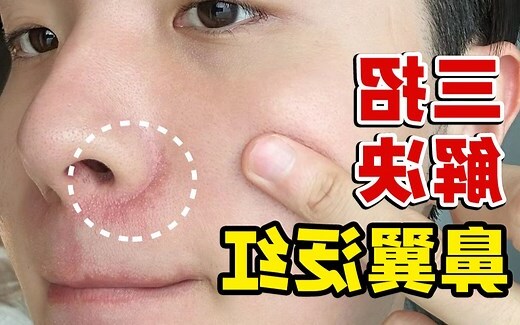 鼻翼泛紅原因