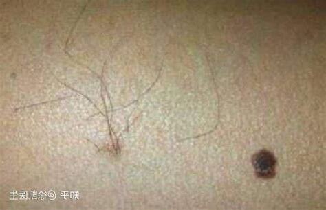 痣上面長毛
