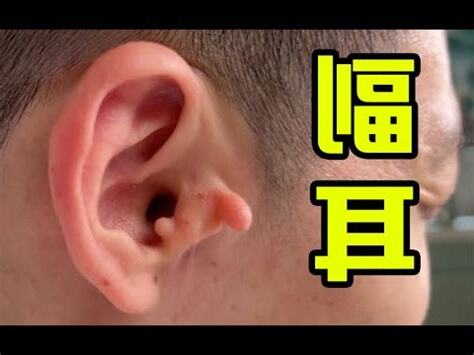 耳朵肉珠