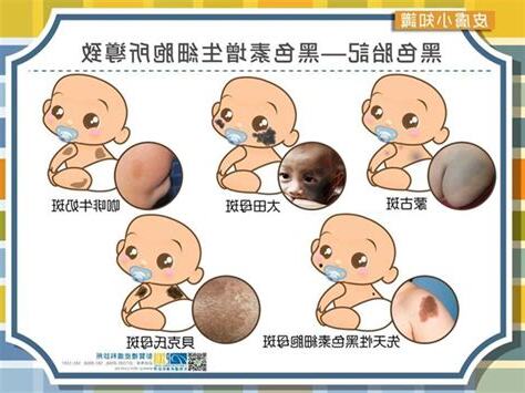 嬰兒屁股胎記