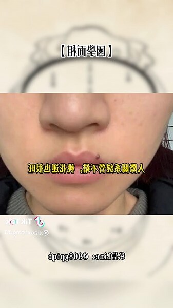 鼻頭旁邊有痣