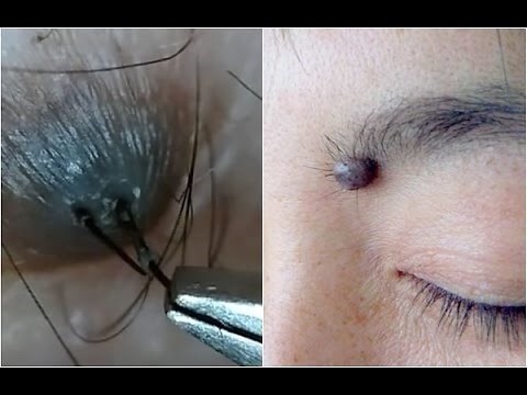 痣上面的毛可以拔嗎