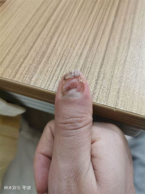 指甲斷了