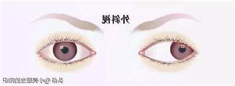 斜視判斷