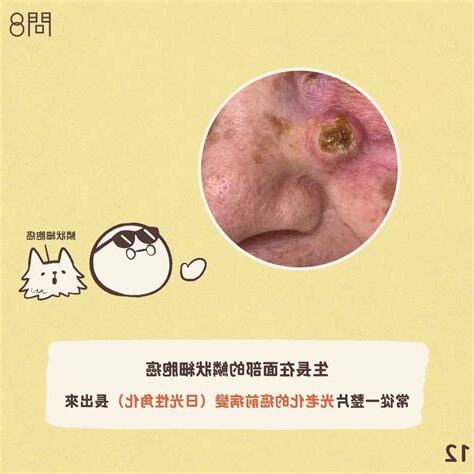 懷疑皮膚癌