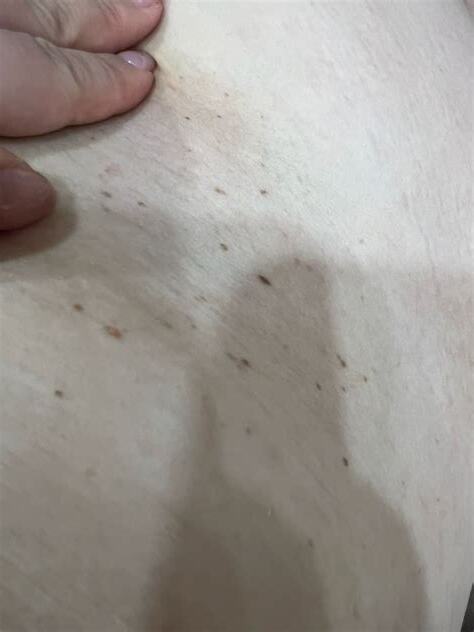 懷孕長痣