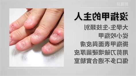 小拇指沒有指甲