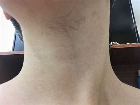 脖子長毛可以拔嗎
