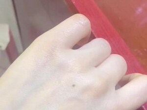 手背有痣左手