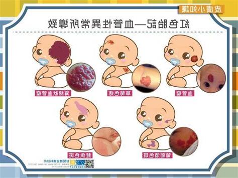 胎記位置意義
