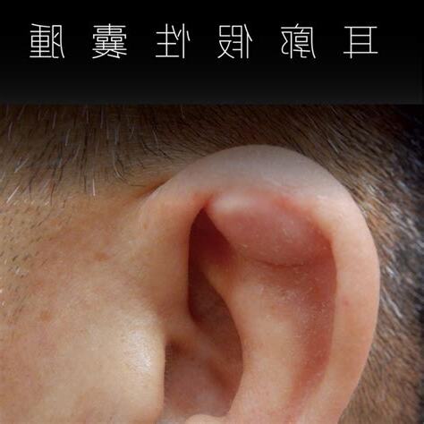耳垂腫起來會痛