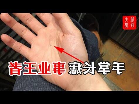 男人右手掌突然長痣