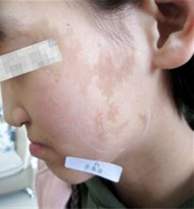 咖啡牛奶斑