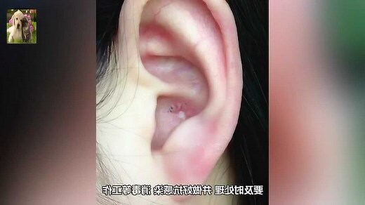 耳珠長痘痘