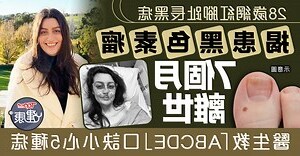左腳小拇指有痣