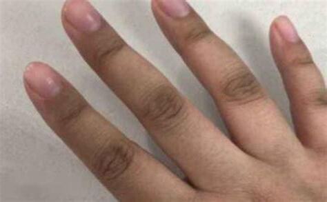 手指第一節黑