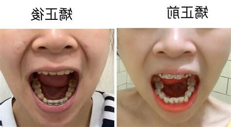 下排牙齒歪斜