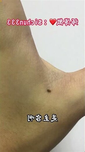 手背虎口有痣