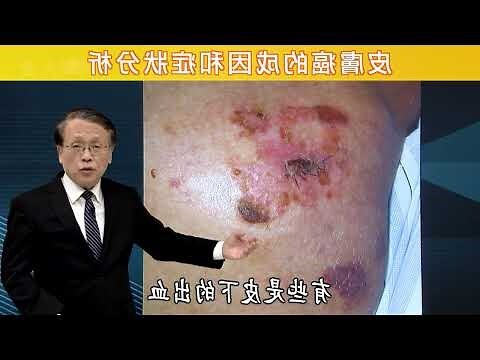 懷疑皮膚癌